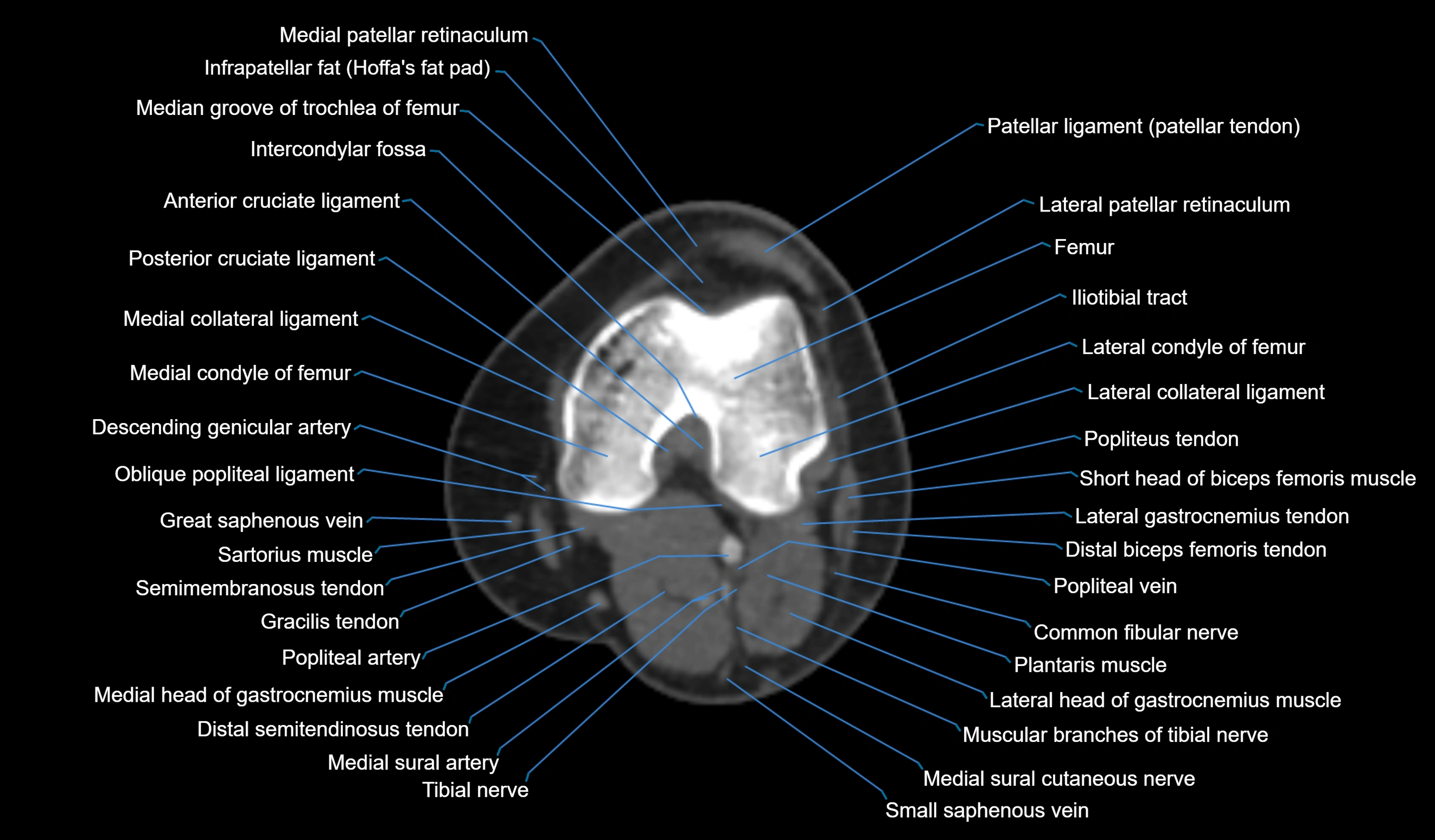 CT knee axial cross sectional anatomy labelled image-00031.webp